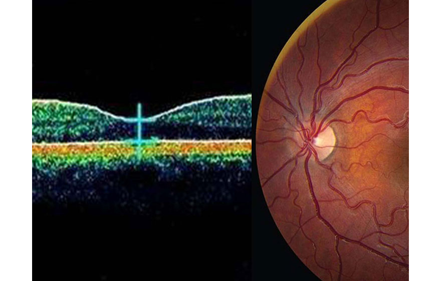 Han's Scanner Galvatron trong hình ảnh Ophthalm.